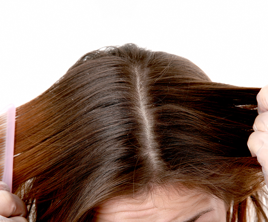 Removes Dandruff